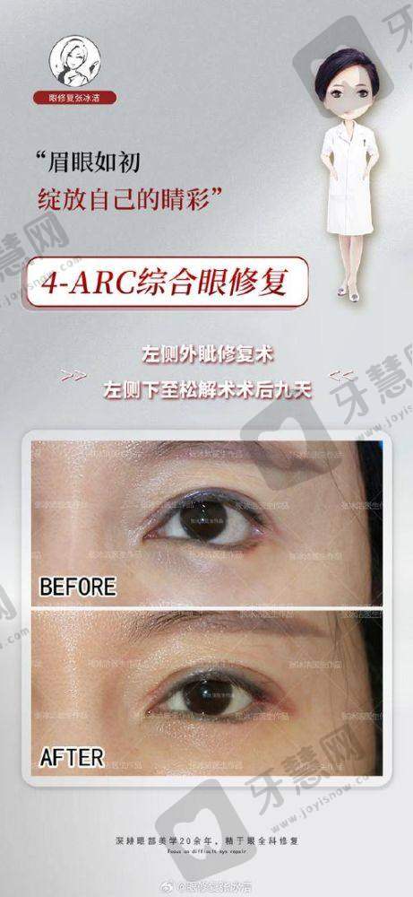 肿泡眼割双眼皮术后护理避坑指南