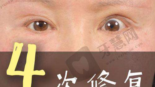 辽宁曙光整形医院白迪适合人群及避坑要点:这些情况找他准没错!