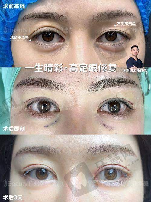 信号1：看时间——术后6个月是“分水岭”