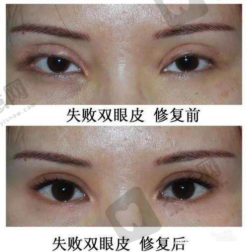 辽宁曙光整形医院白迪怎么样？2025擅长去眼袋/双眼皮技术强|价格5800起口碑好！