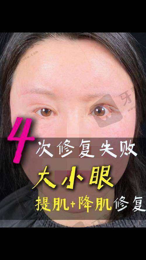 辽宁曙光整形医院白迪去眼袋手术优势解析:三种技术解决不同“眼袋难题”