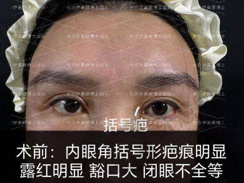 上睑下垂修复手术能保持多久?术前必看:3个决定成效持久性的关键选择