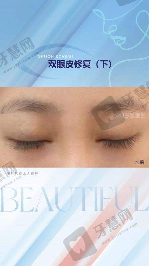 二、上睑下垂修复手术和第一次间隔多久？2025年全新指南：3个月？6个月？看这3种情况