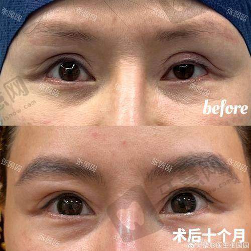 上脸下垂修复手术恢复期多久？术后7天消肿30天逆龄紧致V脸不是梦