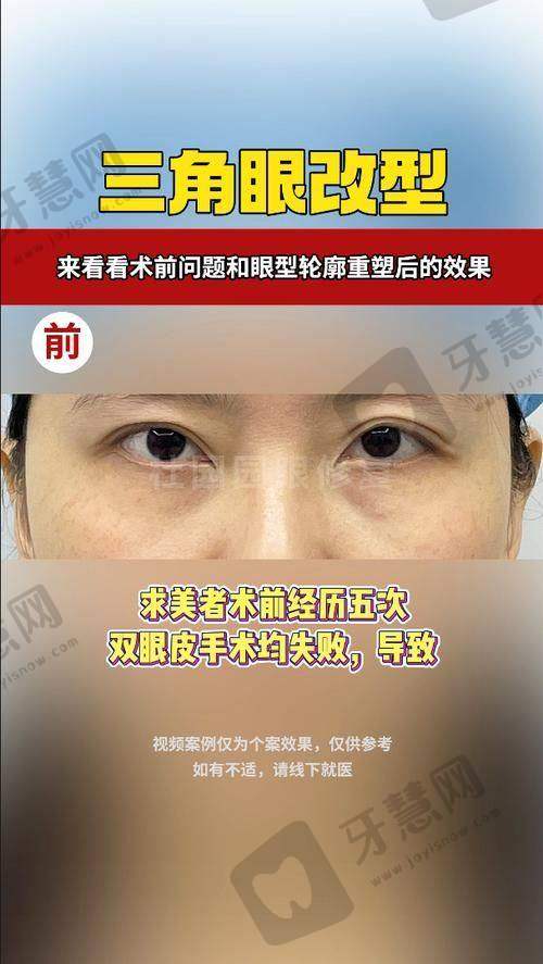 ③ 瘢痕管理：避免“瘢痕牵拉”导致不对称