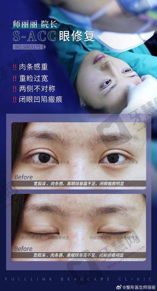 上睑下垂修复手术能保持多久?理性提醒与总结