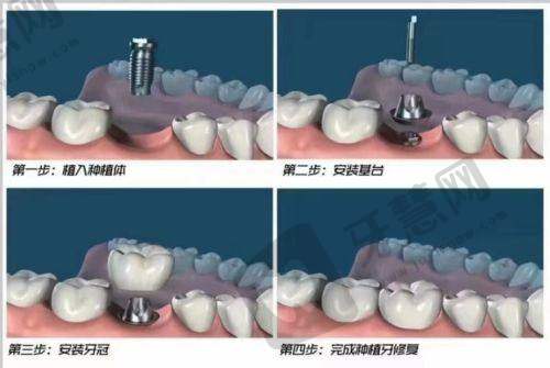 北京德国xive手术价格一览表——北京圣贝口腔门诊部