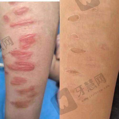 沈阳华美疤痕医院是正规医院吗?适合人群,看看你是不是