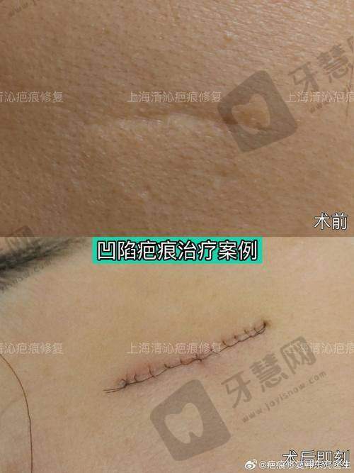 沈阳华美疤痕修复有成效吗?口碑评价真实可查