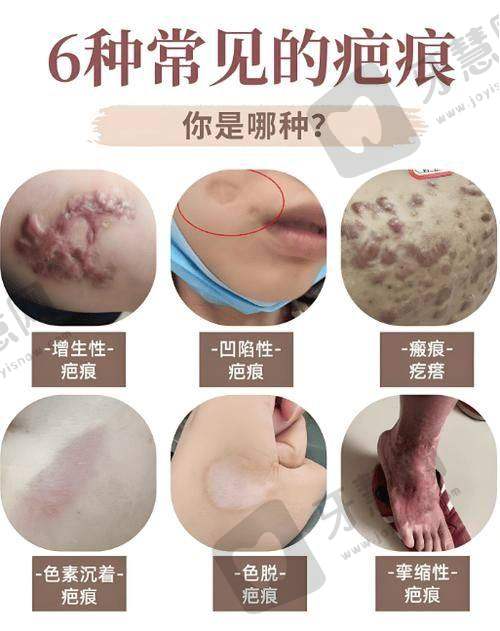 沈阳华美疤痕修复有成效吗?核心技术说了算