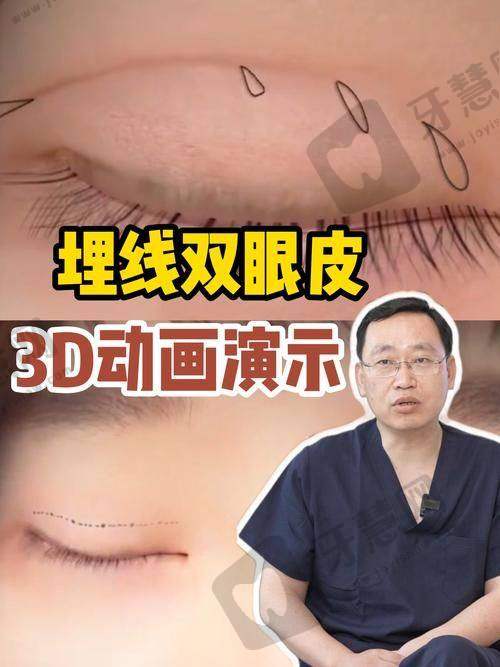 七、沈阳百嘉丽医院双眼皮避坑指南:术前术后这些事一定要注意!