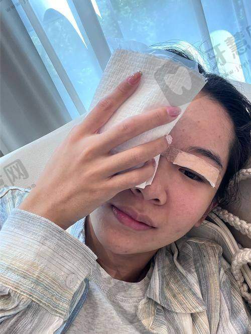 真实实例：从“三眼皮显老”到“灵动双眼皮”，她们经历了什么？