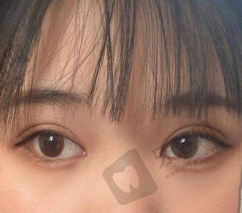 睑缘切口双眼皮是恒久的吗?真人实例告诉你10年后的变化