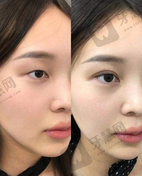 肿泡眼割双眼皮要多少钱?你的“眼部情况”才是定价关键!