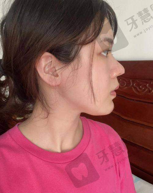 实例1：眼修复患者张女士（32岁）