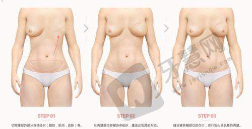 六、男人乳房大的遗传因素:家族性疾病的遗传倾向