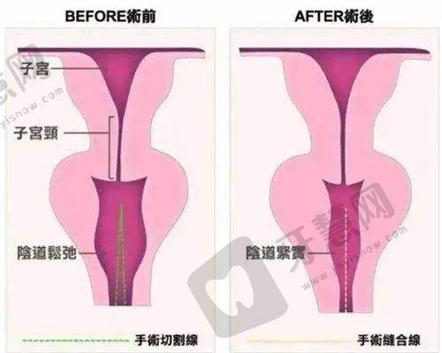 五、男性乳房大怎么减下去?药物诱发型:停药与调理双管齐下