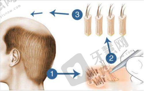 五、男性雌化胸怎么减下去:医疗干预手段