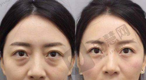 东莞双眼皮修复必看！排名前十的眼修复医生曝光，詹慧、游定良领衔