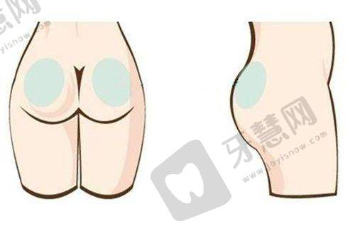 男性乳房肥大需要治疗吗？3种情况教你判断要不要干预