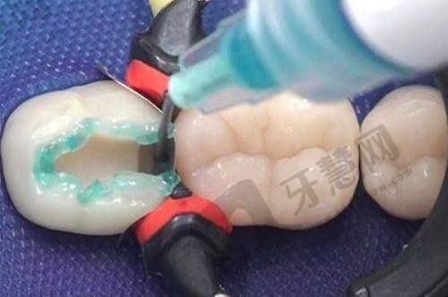 5. 狮山正夫口腔门诊部种植牙价格表