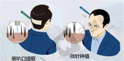 北京禾美嘉BHT植发24000元起项目简介
