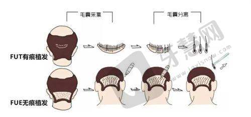 北京禾美嘉BHT植发24000元起医生简介
