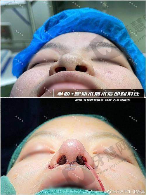 北京圣梦鞍鼻矫正26750元起预约方式