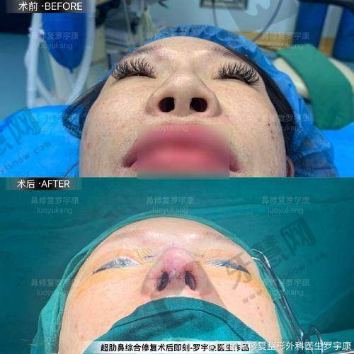 北京小芙生长因子隆鼻取出23900元起，专业团队操作创伤小且术后护理服务贴心