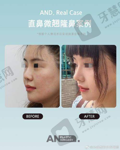 北京圣梦鞍鼻矫正26750元起优势有哪些