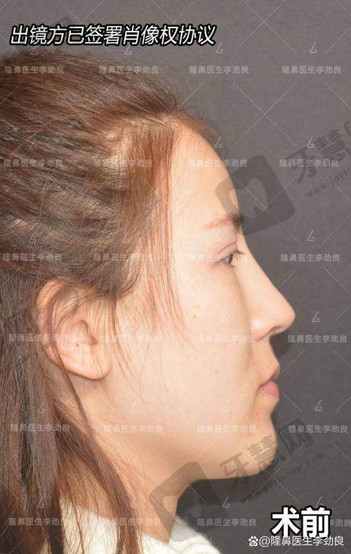 北京大麦植发自体筋膜隆鼻26750元起优势全方面详解
