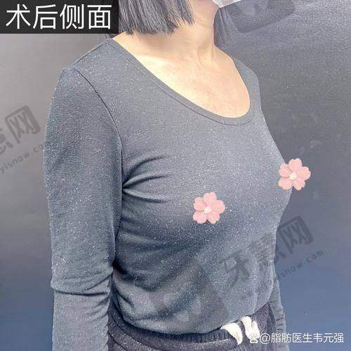 北京蕾士悦容假体 + 自体脂肪丰胸 86750 元起划算吗