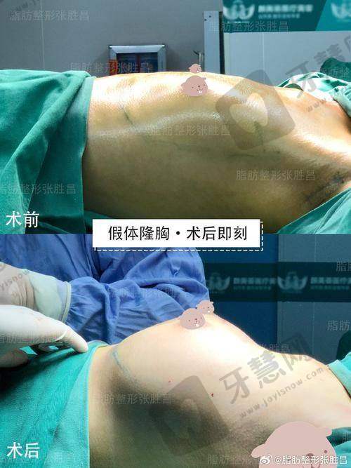 北京蕾士悦容假体 + 自体脂肪丰胸 86750 元起顾客实例