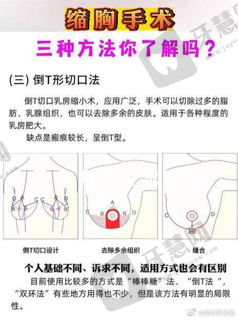 北京叶子胸部假体取出20750元起顾客实例设想