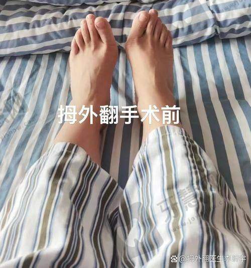北京圣嘉新苏敬达用微孔弧技术修复7年畸形大脚骨，外地患者预约攻略大公开