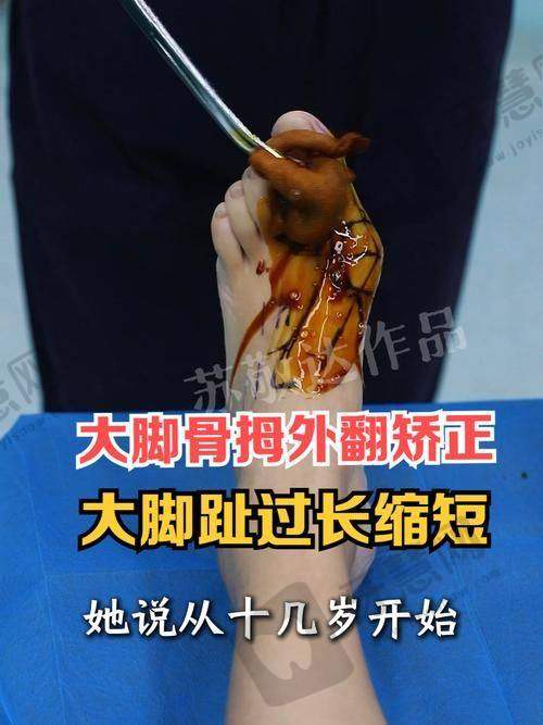 微孔弧技术：修复领域的革命性突破