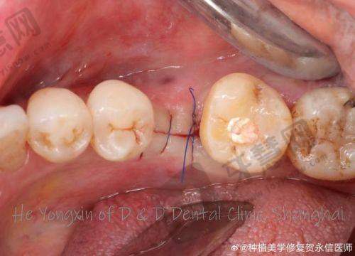 沈阳大东区牙科种植牙收费价目表最新查询:数字化微创即刻种植技术揭秘,多品牌种牙价格低至848元起!
