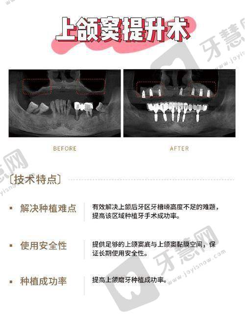 佛山狮山镇牙科医院种植牙一般多少钱一颗?