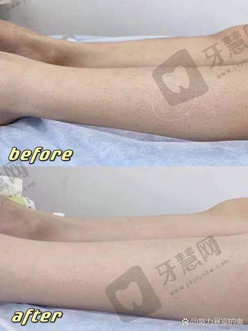 大连思特朗美容医院激光脱毛个性化