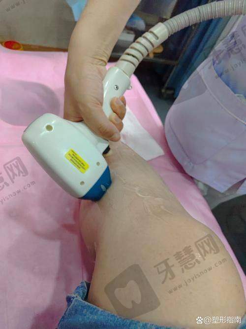 大连激光脱毛哪家医院好？安利大连医科大学附一院/瑞丽门诊，效果超棒！