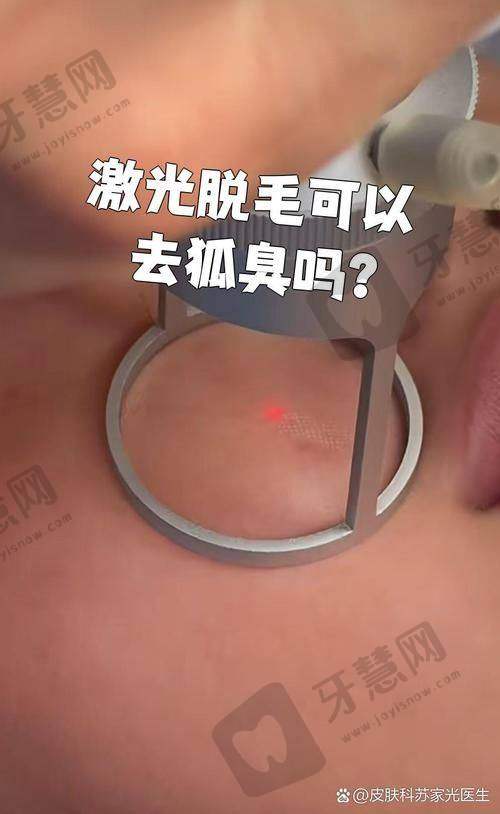 大连艺星医疗美容医院激光脱毛技术