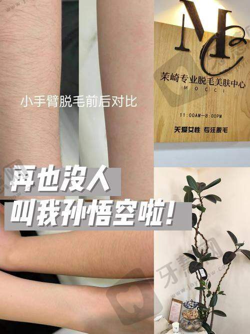 大连爱思特美容医院激光脱毛成效保护