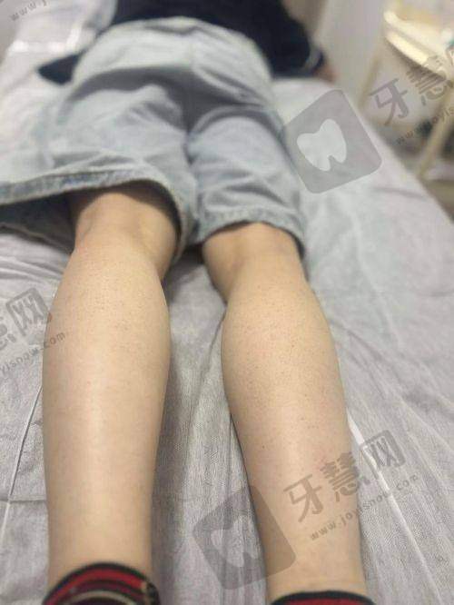 大连丽人医疗美容医院激光脱毛安心持久