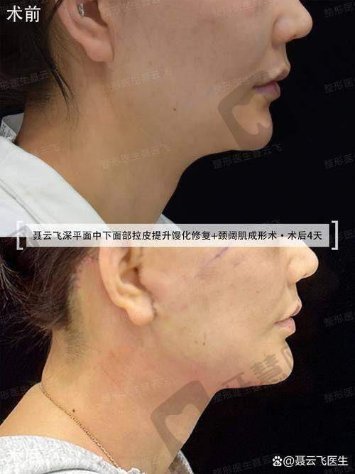 北京加减美穆宝安拉皮手术成效实例精彩分享
