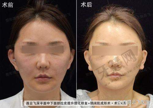 北京加减美穆宝安拉皮行业影响力和口碑深度探究