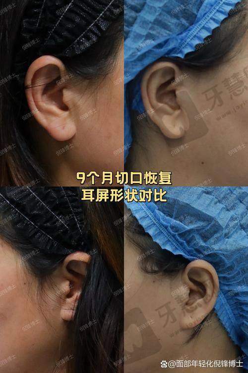 北京加减美穆宝安拉皮技术优势全方面剖析