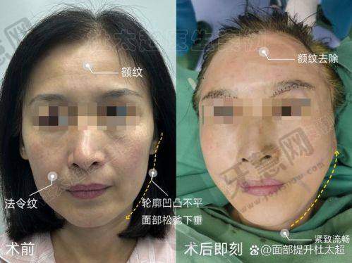 北京加减美穆宝安拉皮技术特色详细解读