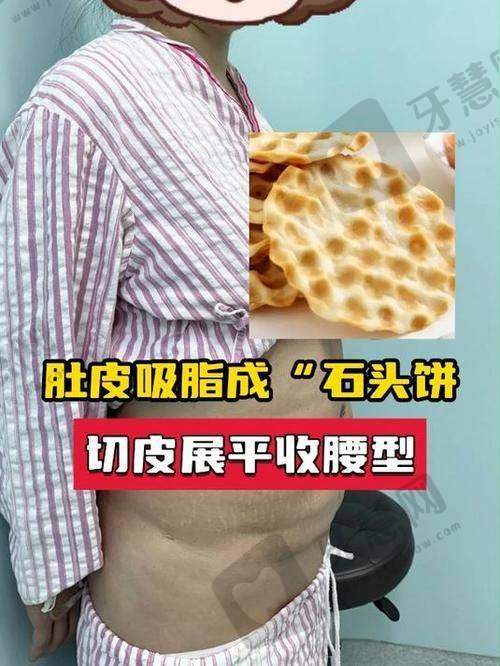 重庆军美整形医院吸脂唐国强与章小平医生怎么选？技术对比及选择攻略来了