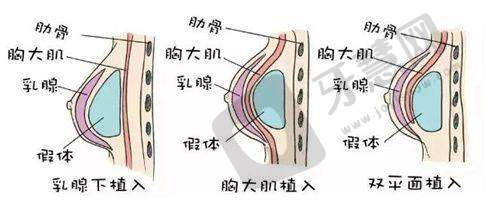 叶桐江医生消除富贵包的专项加压套作用