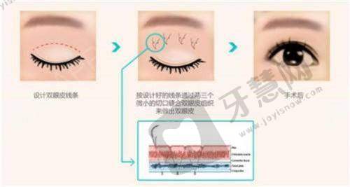 福州莳肌医疗美容诊所身体塑形项目